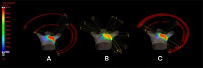 Evaluation of Hybrid VMAT Advantages and Robustness Considering Setup Errors Using Surface Guided Dose Accumulation for Internal Lymph Mammary Nodes Irradiation of Postmastectomy Radiotherapy